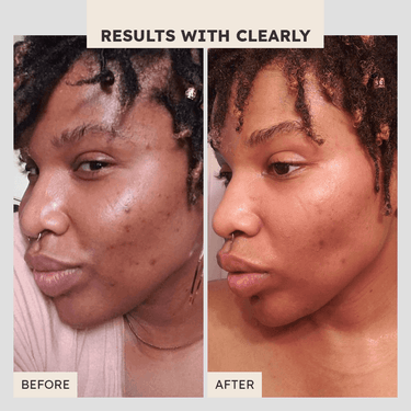 Clear Out Clarifying Lotion - Clearly Basics
